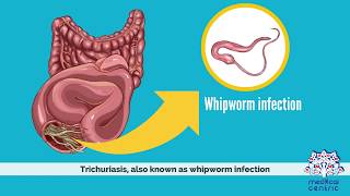 Trichuriasis Causes Signs and Symptoms Diagnosis and Treatment [upl. by Lewes]