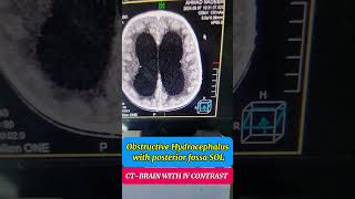 Obstructive hydrocephalus  Posterior fossa SOL  CT scan brain  Radiology  Brain tumor [upl. by Rudelson]