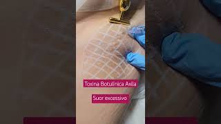 Toxina Botulínica  Axila dralucianamaluf mundodermato botox [upl. by Balling]