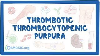 Thrombotic thrombocytopenic purpura NORD [upl. by Barret]