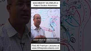 MACHINERY MURMUR In Patent Ductus Arteriosus shortvideo shorts drnajeeb lecture [upl. by Eillen603]