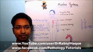 Marfan Syndrome  Part 1 HD [upl. by Oriana]