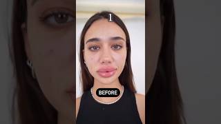 Lip Filler Rehab From Overfilled to Natural 🤩 lipfillerinjections cosmeticsurgery [upl. by Annayrb]