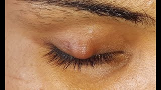 Chalazion Incision amp Curettage HD [upl. by Josh]