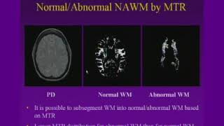 White Matter Disease CT and MRI [upl. by Pettit]