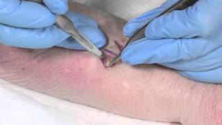 How to Suture  part 4 the Z plasty [upl. by Bevin]