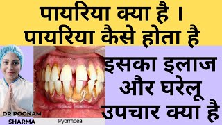 पायरिया क्या है  पायरिया कैसे होता है  पायरिया का इलाज और घरेलु उपचार  Treatment Of Pyorrhea [upl. by Fidele]