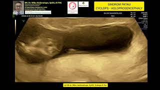 Sindrom Patau Holoprosencephaly  Cyclops 13 weeks [upl. by Haswell432]