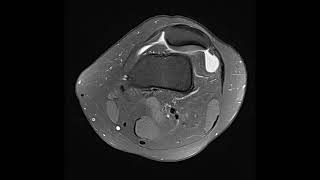 Trochlear dysplasia [upl. by Ohcamac]