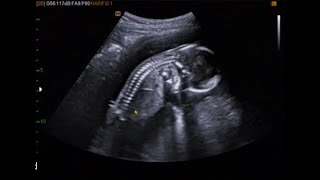 fetal ultrasound of 16 weeks 17 weeks baby boy moving [upl. by Guria471]