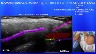 Ultrasound Guided Scapulothoracic Bursa Injection in a 32 Year Old Female by probeultrasoundcom [upl. by Leatri718]