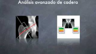 DIAGNOSTICO PRECOZ OSTEOPOROSIS [upl. by Miko]