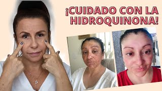 EFECTOS DE LA HIDROQUINONA 😱 UN TESTIMONIO SORPRENDENTE  ADRIANA VIEIRA [upl. by Veta205]