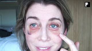 Blepharoplasty Video Diary  2 Weeks After Surgery 10 of 15 [upl. by Notgnirrab]