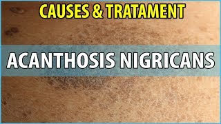 What is Acanthosis Nigricans Causes Symptoms and Treatments [upl. by Ahseniuq]