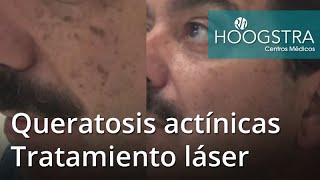 Queratosis actínicas  Tratamiento láser 21035 [upl. by Danais]