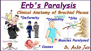 Erbs paralysisBrachial Plexus InjuryErbs PalsySimplified Anatomy Deformity Disabilityin hindi [upl. by Aek199]