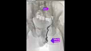 Varicocele Embolisation Angiography venogram of left gonadal vein in a man suffering from [upl. by Nawotna]