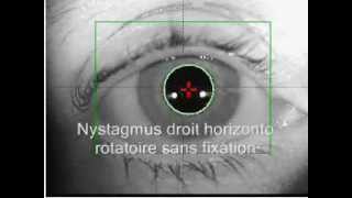 Nystagmus horizontal et rotatoire sans et après fixation [upl. by Samp]