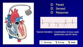 Pacemaker Modes and Settings [upl. by Raffin]