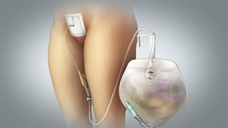 Suprapubic Catheter Care Discharge Instructions [upl. by Nyvlem]