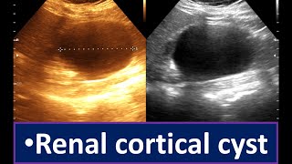 Renal cortical cyst  Abdominal ultrasonogram  Sonographic prediction cortical cyst [upl. by Mesics]