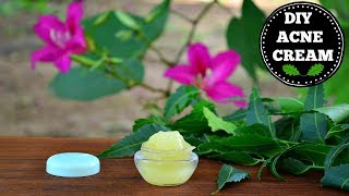 DIY Acne amp Acne Scar Removal Cream That Really Works CLINICALLY PROVEN [upl. by Airdnaid]