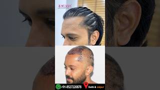 The Best Hair Transplant Results in India by Dr Suneet Soni at Medispa Hair Transplant Centre [upl. by Nesnah]