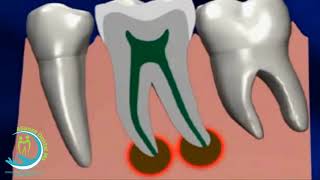 ¿Que es una endodoncia [upl. by Crifasi]