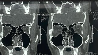 CT Nose and Paranasal Sinuses Anatomical View Part 2 [upl. by Strander590]