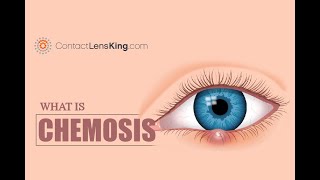 What is Chemosis Eye Inflammation Causes and Symptoms [upl. by Dnilasor]