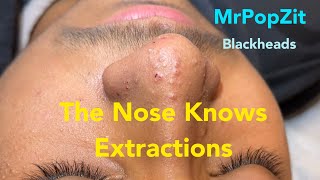 Nose extractions Blackheads whiteheads miliaKeratin plugs extracted with deep squeeze Pore dirt [upl. by Skell]