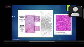 Poorly differentiated thyroid cancer management PDTC  Practical Implications Dr Saumyta [upl. by Mauer914]