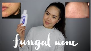 MALASSEZIA FOLLICULITISFUNGAL ACNE Tiny Forehead Bumps  My Experience and Treatment  jskavee [upl. by Kubis827]