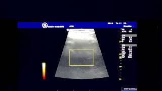 Nerves of the Anterior Hip triangle [upl. by Rayburn]