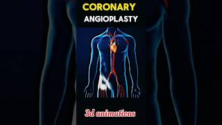 Coronary Angioplasty process shorts viral tranding coronary [upl. by Berkly]