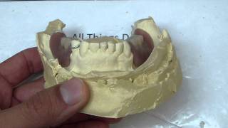 Removable Denture Clasp Repair Part 3  Denture on Cast [upl. by Karlee]