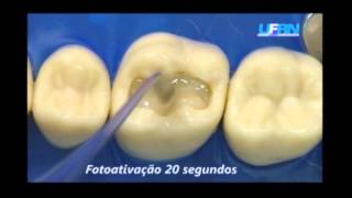 RESTAURAÇÃO RESINA COMPOSTA CLASSE I ACOES INTEGRADAS DENTISTICA [upl. by Maryn887]