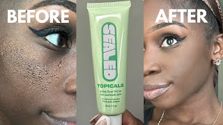 TOPICALS SEALED THE BEST PRIMER EVER INDENTED ACNE SCARS LARGE PORES [upl. by Bette-Ann]