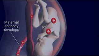 Jaundice Hemolytic Disease quotErythroblastosis fetalisquot in Newborn [upl. by Chu]