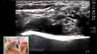 ULTRASOUNDGUIDED SUPRACLAVICULAR NERVE BLOCK [upl. by Gleeson183]