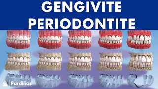 Gengivite periodontite e a sua evolução © [upl. by Nikolai491]