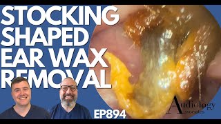 STOCKING SHAPED EAR WAX REMOVAL  EP894 [upl. by Stanhope]