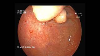 कोलोनोस्कोपी करने पर मिला बड़ी आंत में गांठ  Colonic polypoidal lesion at cecum  GASTROLIVER [upl. by Homans429]