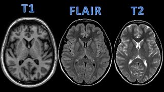 RM do Crânio T1 T2 e FLAIR [upl. by Annahc605]