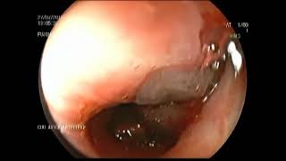 How to get rid of tape worm infestation in adults  Dr Sharat Honnatti [upl. by Nonez86]