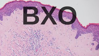 Balanitis Xerotica Obliterans BXO  Pathology mini tutorial [upl. by Adamski493]