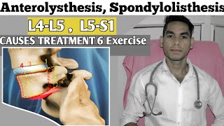 Anterolisthesis spondylolisthesis L5s1 spondylolisthesis Treatment Exercise Low back pain [upl. by Kanal]