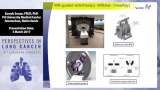 New radiotherapy techniques for the treatment of lung cancer [upl. by Sarid330]