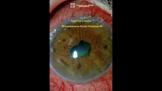 Granulomatous Keratic Precipitates Anterior Uveitis [upl. by Lindblad470]